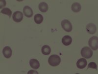 Schistocytes