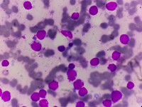 Imprint smear showing blast like lymphoid cells with prominent nucleloli