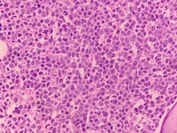 Bone marrow biopsy-infiltration by large lymphoid cells with prominent eosinophilic nucleoli