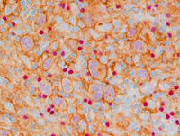 PD-L1/PAX5 dual immunostaining in Reed-Sternberg cells