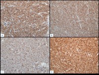 TLymphoblastic-Lymphoma--Additional-IHC
