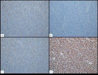 TLymphoblastic-Lymphoma--IHC