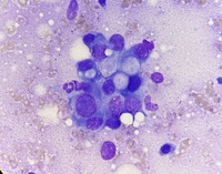 Metastatic gastric cancer cells 2