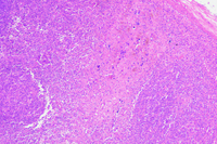 Hematoxylin body - Lupus lymphadenopathy 1