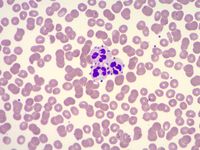 Photomicrographs from a peripheral blood smear displaying prominent platelet satellitism (Wright-Gie