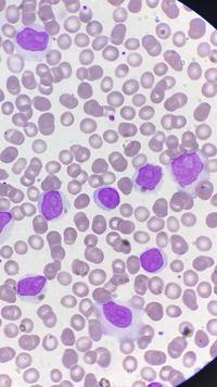 Prolymphocytic progressive CLL/SLL 1