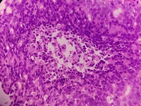 Bone marrow biopsy -High power view of the atypical cells arranges in glands