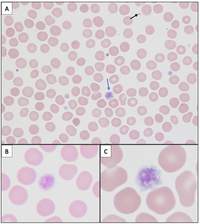Macrothrombocytopenia in DiGeorge Syndrome (del 22q11.2)