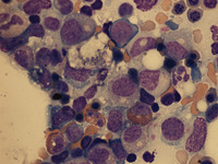Renal transplant patient with Hemophagocytic Lymphohistiocytosis 3