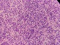 Bone marrow biopsy in high power showing immature lymphoid cells  with irregular nuclear contours