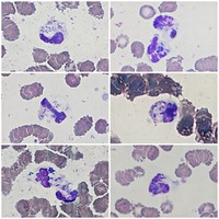 Phagocyting neutrophils in peripheral blood
