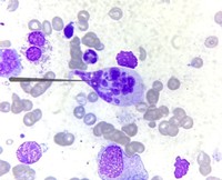 Botryoid neutrophil - In a case of scrub typhus