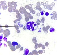 Reactive vacuoles in Botryoid neutrophil