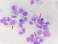Follicular lymphoma cells in bone marrow