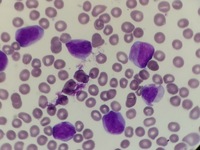 APL variant (FAB:AML-M3v) 4