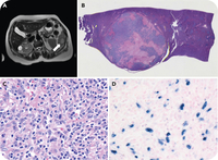 EBV-positive inflammatory FDC/FRC tumor: no longer pseudo or sarcoma!