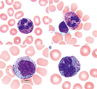 Neutrophils and monocytes with increased azurophilic granules resembling toxic changes in mucopolysaccharidosis type VI