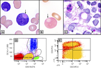 B-acute lymphoblastic leukemia with eosinophilic inclusions