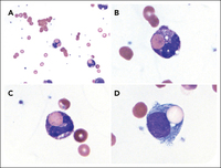 Peripheral erythrophagocytosis in paroxysmal cold hemoglobinuria