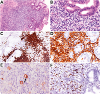 Epstein-Barr virus–positive mucocutaneous ulcer of the stomach