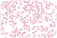 Four genetic red cell disorders in one
