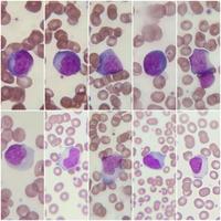 Infectious mononucleosis