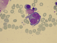 Reed-Sternberg Cell