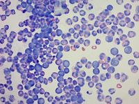 AML involving left knee joint 1