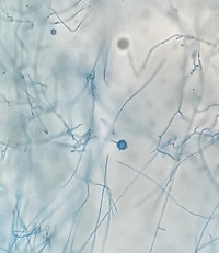 Disseminate Histoplasmosis 3