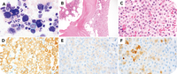 A rare case of well-differentiated systemic mastocytosis