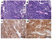 Plasma cell neoplasm with papillary architecture mimicking carcinoma