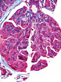 Hyaline Microthrombi