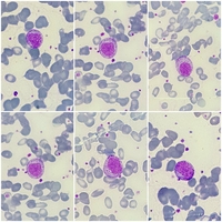 promyelocytes
