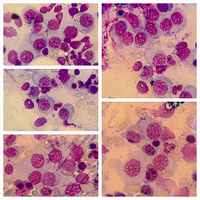 Multiple Myeloma