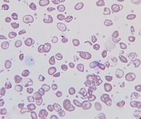 Poikilocytosis