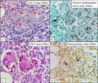 Disseminated cryptococcal infection in a recently diagnosed acquired immunodeficiency syndrome