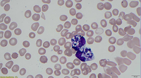 Gram positive cocci- Enterococcus faecalis