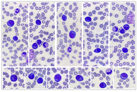Plasmacytoid Lymphocytes in Chickenpox
