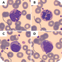 Diagnostic peripheral blood smear for Chédiak-Higashi syndrome in a 43-month-old boy, confirmed by sequencing