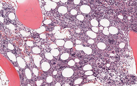 Bone Marrow Biopsy 1
