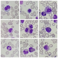 Myelodysplastic Syndrome