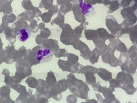 Bilirubin crystals 3