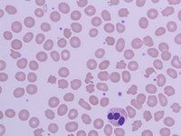 Peripheral smear 100X, Leishman Stain showing multiple acanthocytes along with one Eosinophil