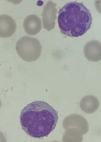 Sezary Cell 2