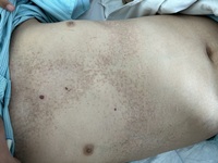Eczematous papules on skin