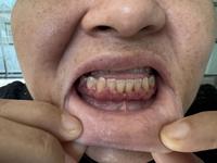 Gingival infiltration by acute myeloid leukemia, in a patient with a monocytic subtype