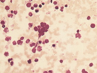 Bone marrow morphology and flow cytometry plots 1