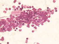 Bone marrow morphology and flow cytometry plots 2