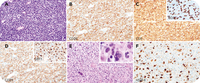 Herpetic lymphadenitis mimicking Richter transformation of chronic lymphocytic leukemia/small lymphocytic lymphoma