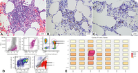 Biclonal mantle cell lymphoma